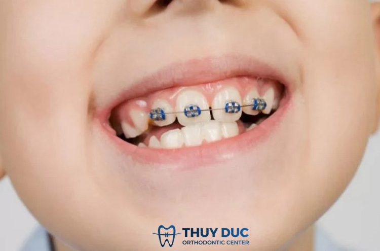 Niềng 1 răng có được không- Chuyên gia giải đáp 1