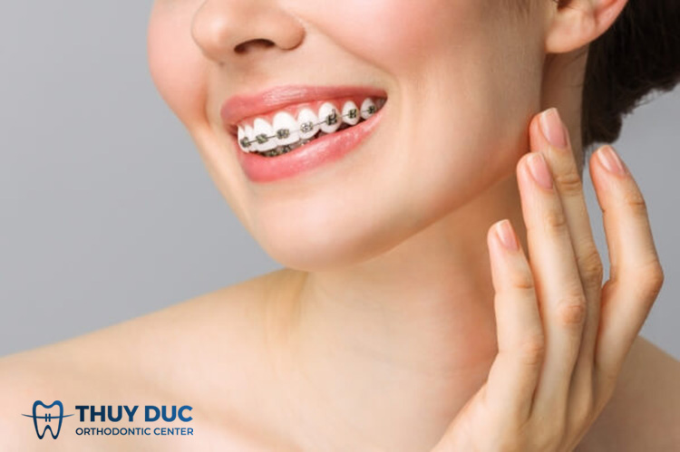 Niềng răng thẩm mỹ 1