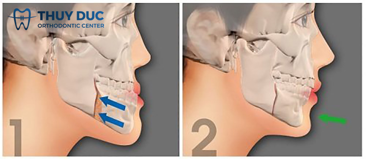 3.2. Khắc phục hàm móm 1 3.2. Khắc phục hàm móm 1