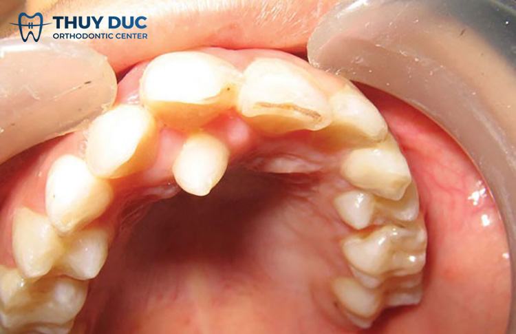 1. Vì sao có trường hợp người có 36 cái răng? 1