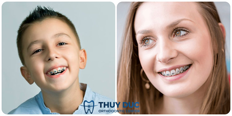 Sự khác biệt giữa niềng răng trẻ em và người lớn 1
