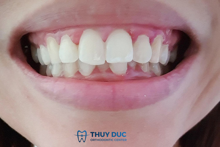Các tình trạng răng cửa to thường gặp 1