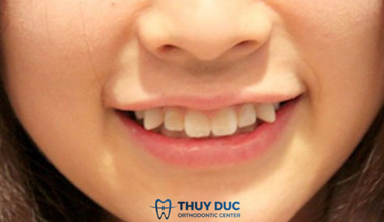 Tướng răng hổ – Vận mệnh và cách khắc phục tốt nhất