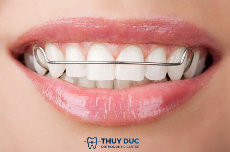 Lý do cần chăm sóc sau khi niềng răng? 1