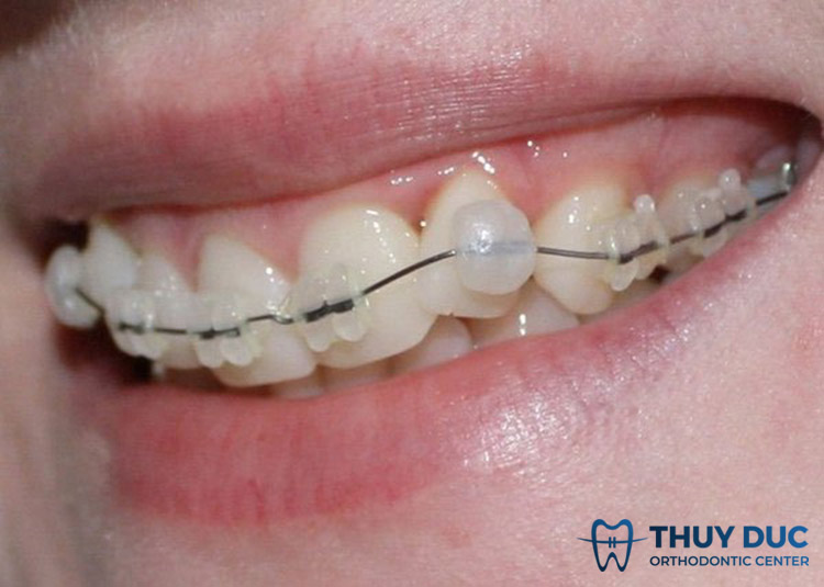 4. Làm sao để không bị nhiệt miệng khi niềng? 1 Sáp nha khoa –“cứu tinh” của răng niềng