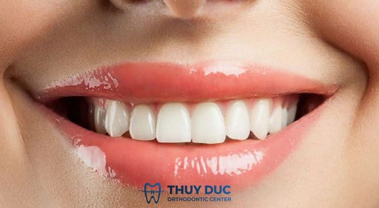 Vì sao bạn nên cải thiện tình trạng răng cửa to? 1