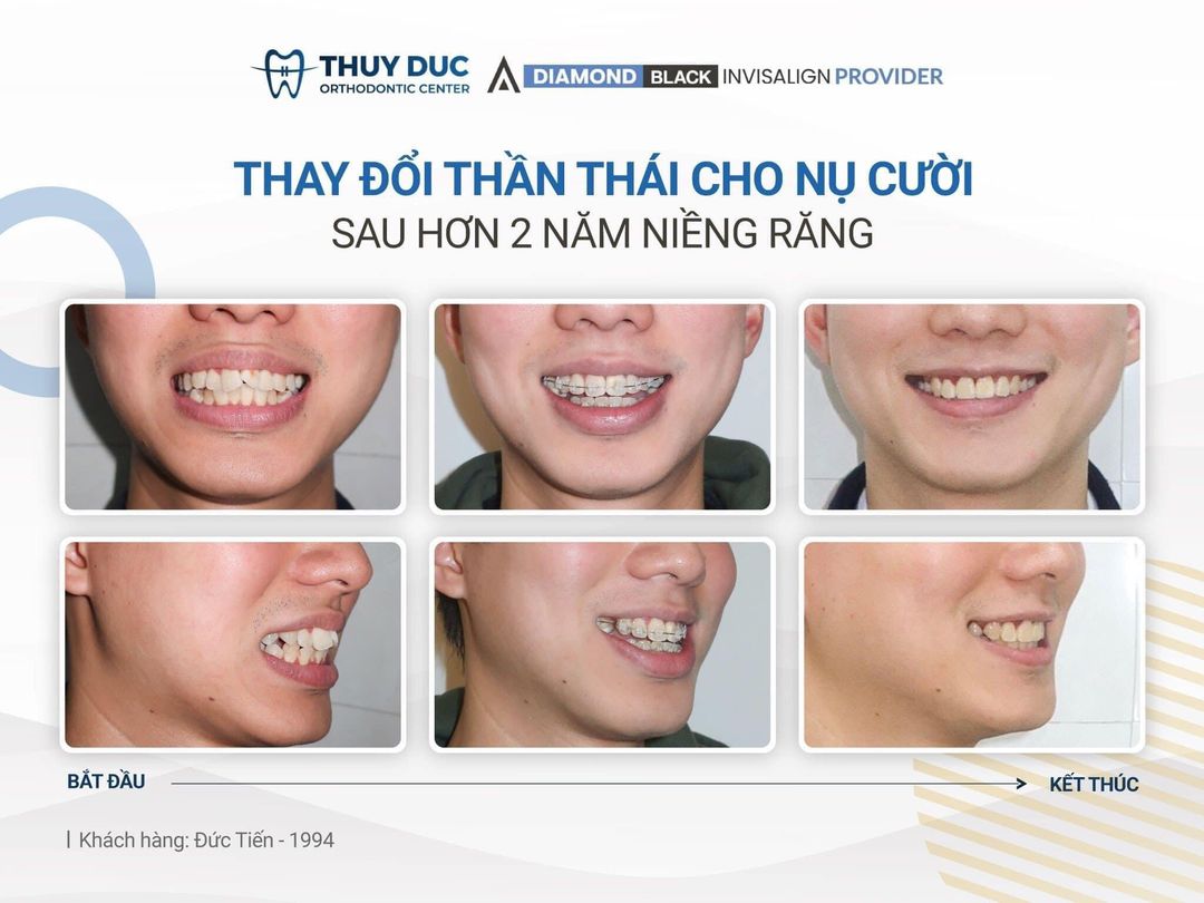 Đâu là cách khắc phục răng khấp khểnh tốt nhất? 1 Đâu là cách khắc phục răng khấp khểnh tốt nhất? 1