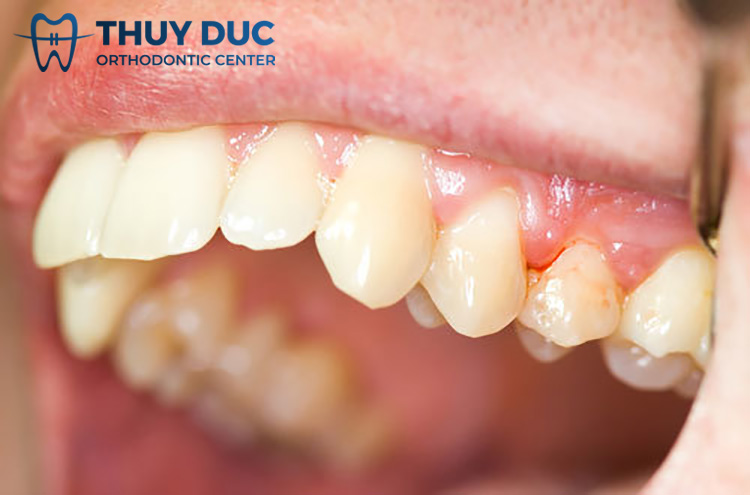 Làm sao để có hàm răng chắc khỏe sau khi niềng? 1 Làm sao để có hàm răng chắc khỏe sau khi niềng? 1