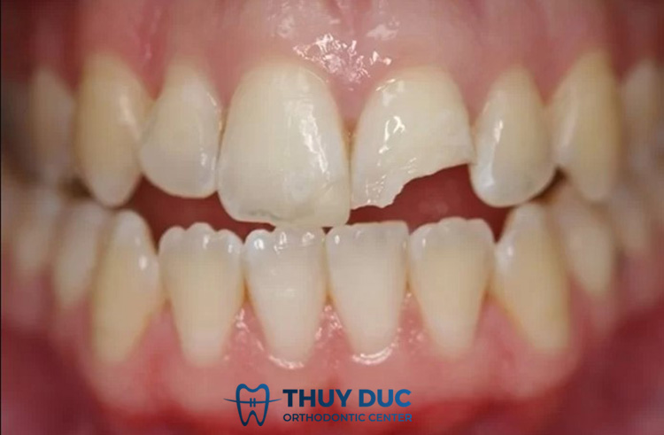 Bị gãy răng phải làm sao? 1
