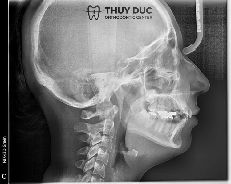 Làm sao để phân biệt hô răng và hô hàm? 1