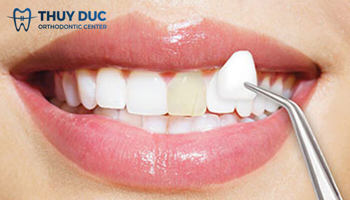 Dán sứ là gì? Có ưu và nhược điểm gì? 1 Dán sứ là gì? Có ưu và nhược điểm gì? 1