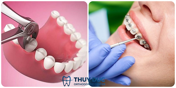 Gắn mắc cài trước mới nhổ răng hay nhổ răng rồi mới gắn mắc cài? 1