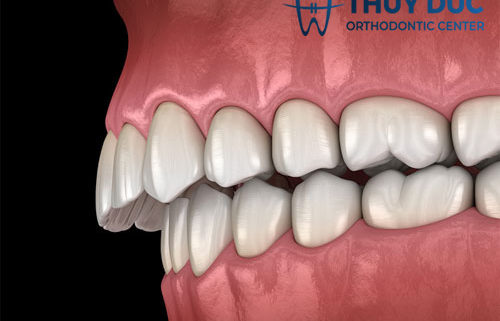 Hô răng và hô hàm khác nhau như thế nào?