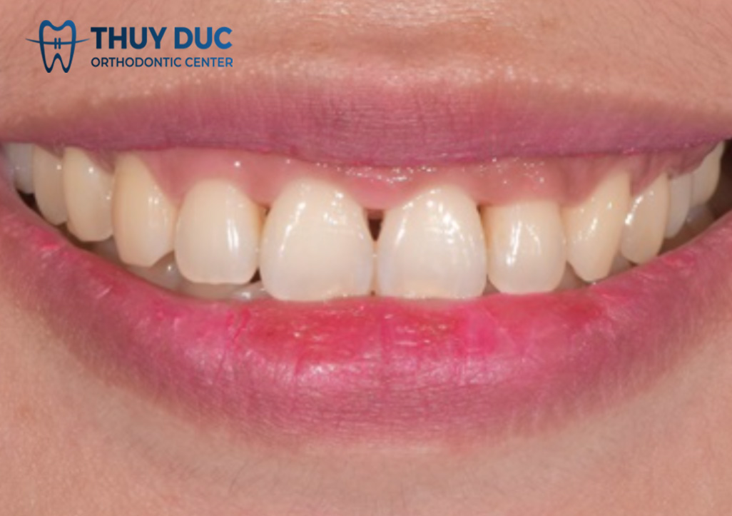 Nguyên nhân dẫn đến tam giác đen khi niềng răng 1 Nguyên nhân dẫn đến tam giác đen khi niềng răng 1