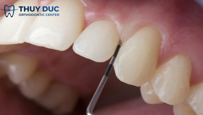 Mài răng 1 Mài răng 1