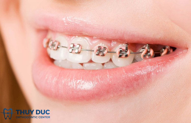 Niềng răng đi xuất khẩu lao động được không? 1 Niềng răng đi xuất khẩu lao động được không? 1