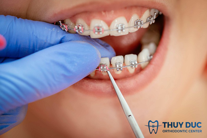 Giải đáp: Niềng răng có bị rụng răng không? 1 Giải đáp: Niềng răng có bị rụng răng không? 1