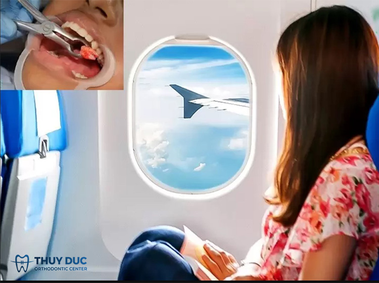 Niềng răng đi máy bay được không? 1 Niềng răng đi máy bay được không? 1