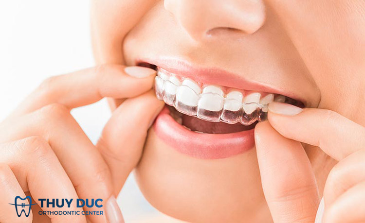 Đi xuất khẩu lao động nên niềng răng loại nào? 1 Đi xuất khẩu lao động nên niềng răng loại nào? 1