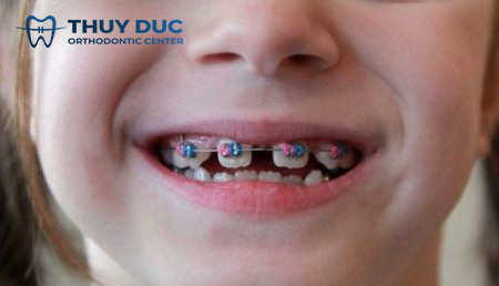 2.3. Niềng răng 1 2.3. Niềng răng 1