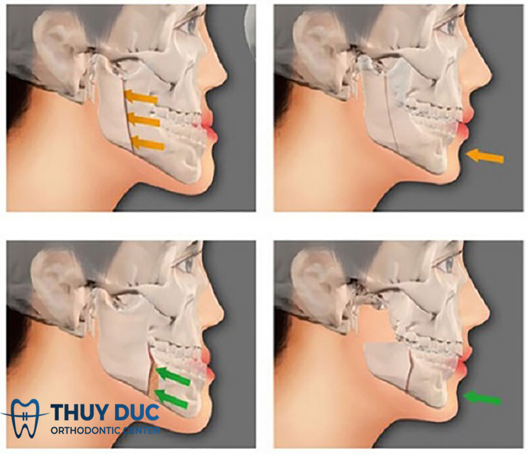 Khắc phục hô hàm 1