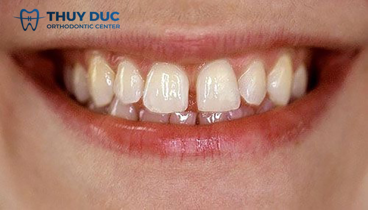 1. Tại sao răng càng ngày càng thưa dần? 1 1. Tại sao răng càng ngày càng thưa dần? 1