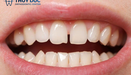 Lý giải tại sao răng càng ngày càng thưa dần?