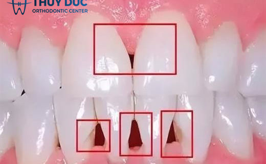 Tam giác đen khi niềng răng là gì?