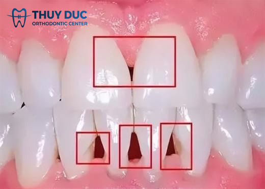 4. Cách chăm sóc răng miệng để hạn chế tam giác đen