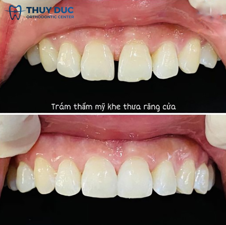 2.2. Hàn trám răng 1 2.2. Hàn trám răng 1