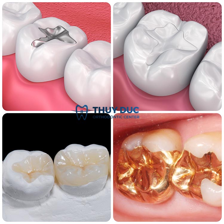 Các vật liệu trám răng thông dụng 1