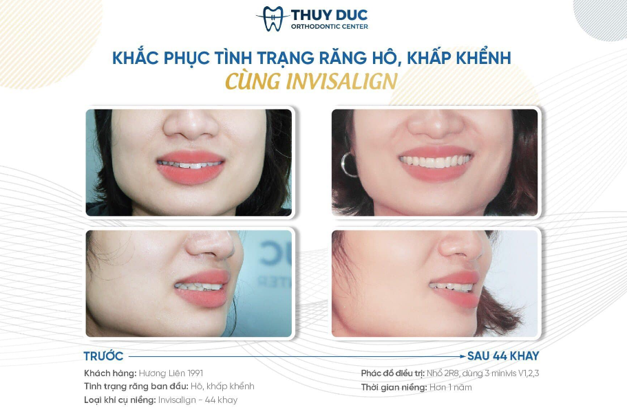 Mách bạn địa chỉ nha khoa niềng răng ít đau, hạn chế nhổ răng 4 Mách bạn địa chỉ nha khoa niềng răng ít đau, hạn chế nhổ răng 4