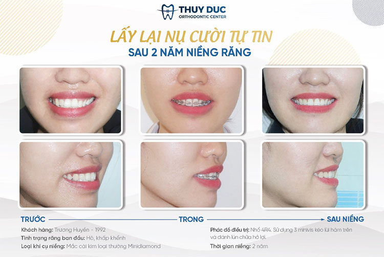 Mách bạn địa chỉ nha khoa niềng răng ít đau, hạn chế nhổ răng 3 Mách bạn địa chỉ nha khoa niềng răng ít đau, hạn chế nhổ răng 3