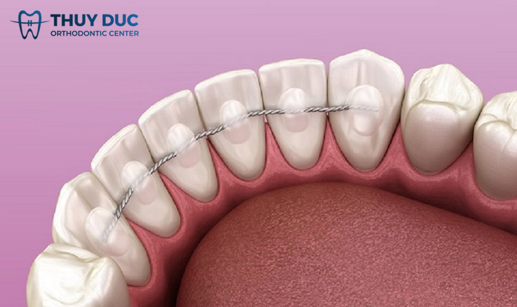 Hàm duy trì cố định kim loại 1 Hàm duy trì cố định kim loại 1