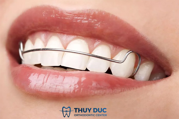 Hàm duy trì tháo lắp bằng kim loại 1 Hàm duy trì tháo lắp bằng kim loại 1