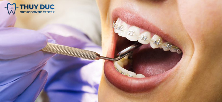 4. Những lưu ý khi niềng răng đã trám 1