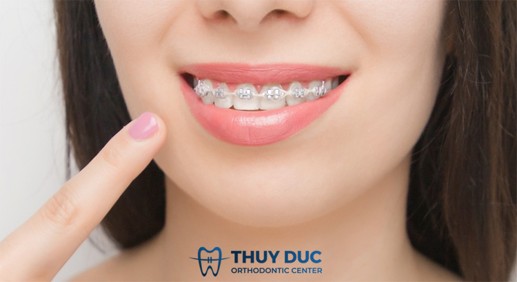 Niềng răng mắc cài kim loại 1