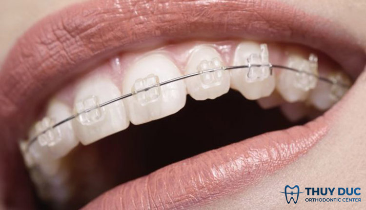 Niềng răng mắc cài sứ 1