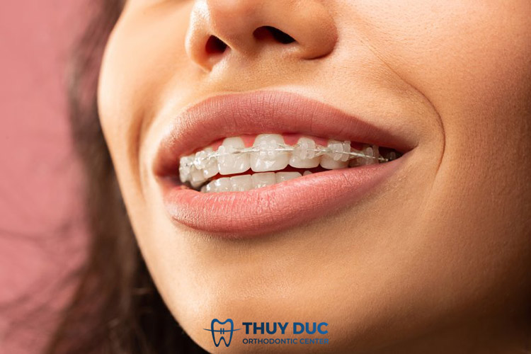 Niềng răng mắc cài sứ 1 Niềng răng mắc cài sứ 1