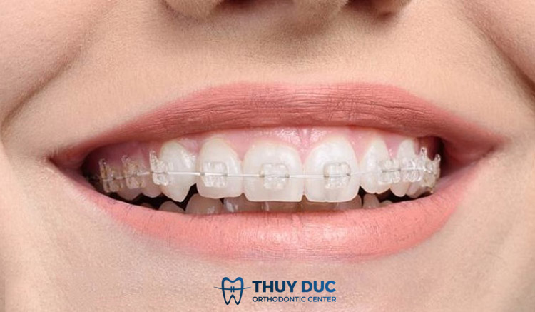 Niềng răng mắc cài sứ 1