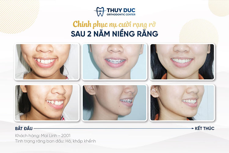 5. Nha khoa Thúy Đức- Địa chỉ niềng răng uy tín 3