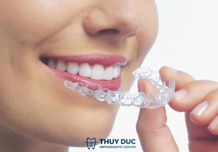 Niềng răng trong suốt Invisalign 1