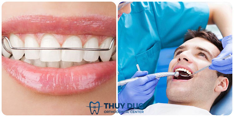 1. Răng bị chạy sau khi niềng do đâu? 1 1. Răng bị chạy sau khi niềng do đâu? 1