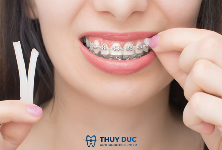 3. Sử dụng sáp nha khoa 1 3. Sử dụng sáp nha khoa 1