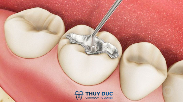 1. Trám răng, hàn răng là gì? 1