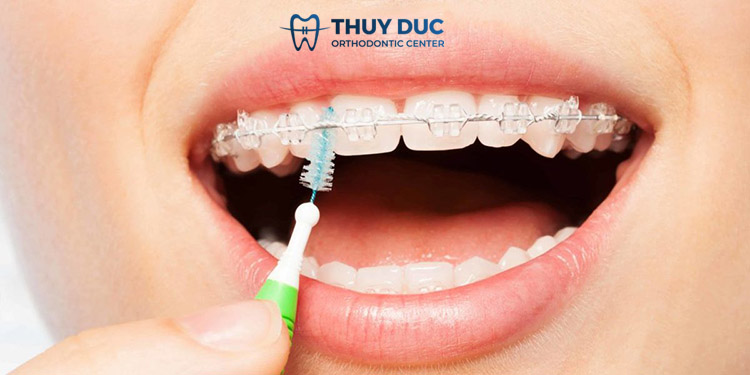 5. Vệ sinh răng miệng khi niềng răng đúng cách 1 5. Vệ sinh răng miệng khi niềng răng đúng cách 1