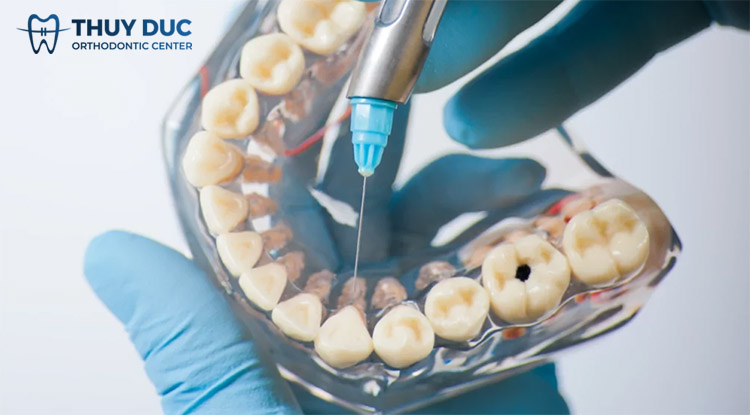 4. Các kỹ thuật gây tê trong nha khoa 1