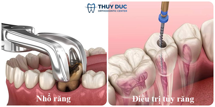 2. Các trường hợp cần phải tiêm thuốc tê vào răng 1