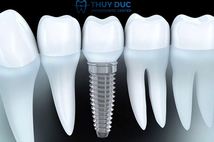 Cấy ghép răng implant 1 Cấy ghép răng implant 1