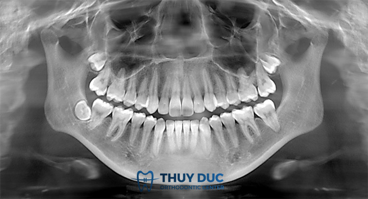 1. Chụp X-quang răng là gì? 1